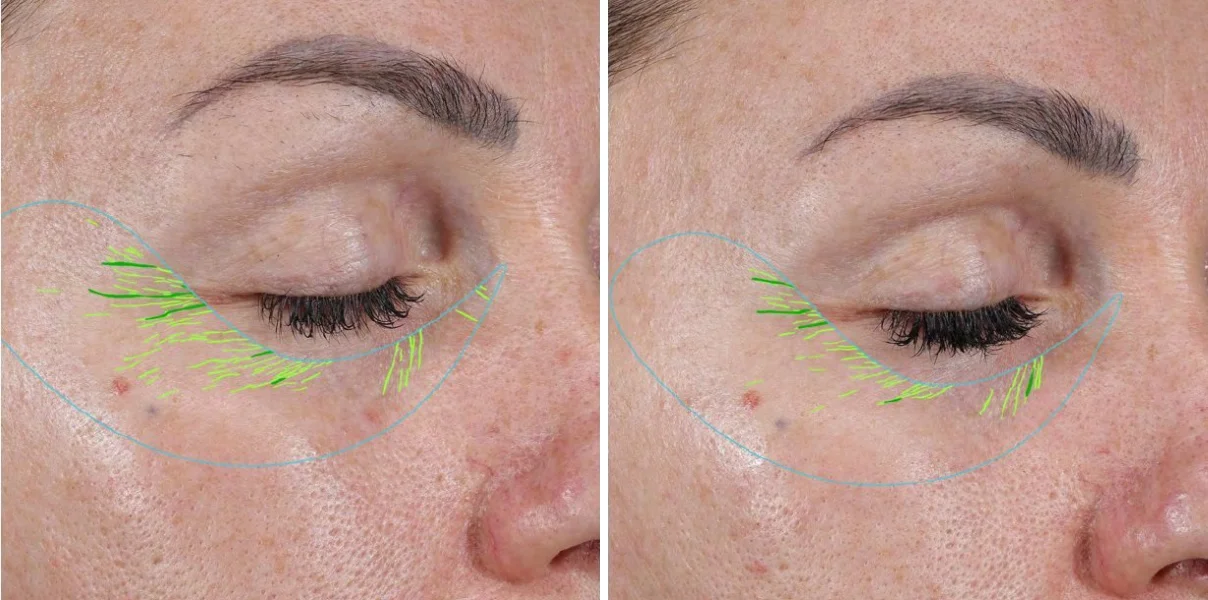 Skin-imaging analysis of the area around a woman's eye before and after 8 weeks