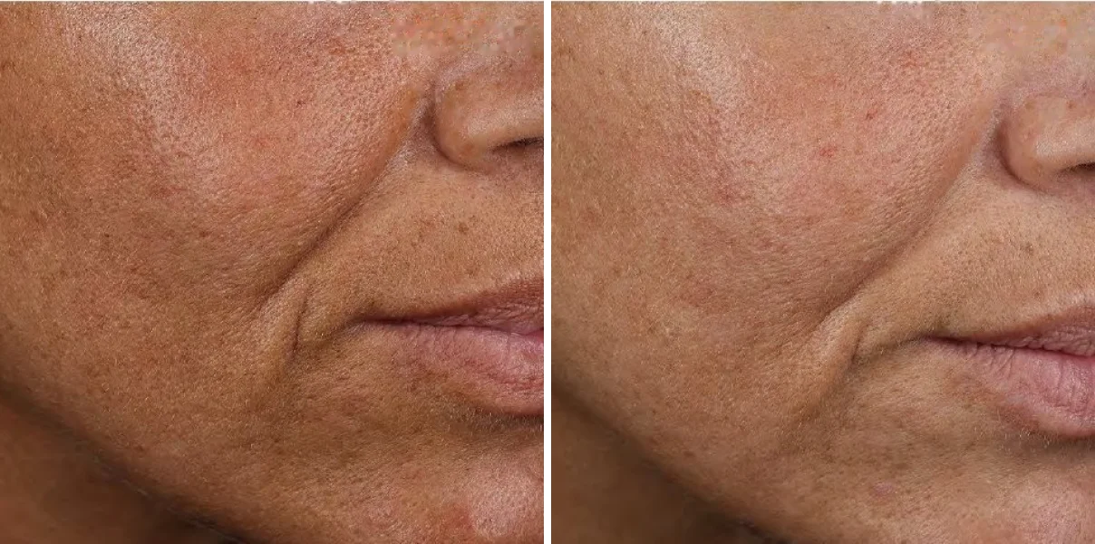 A woman's cheek and smile line before and after 8 weeks