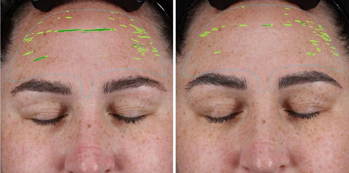 Skin-imaging analysis of a woman's forehead before and after 8 weeks