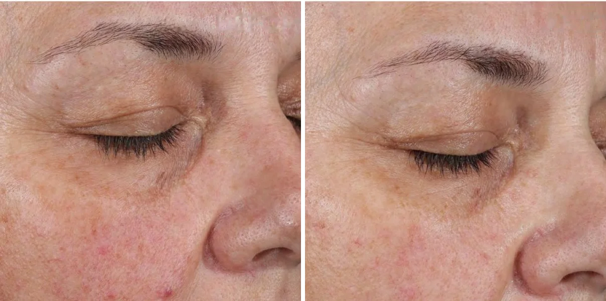 The skin under a woman's eye and across her cheek before and after 8 weeks