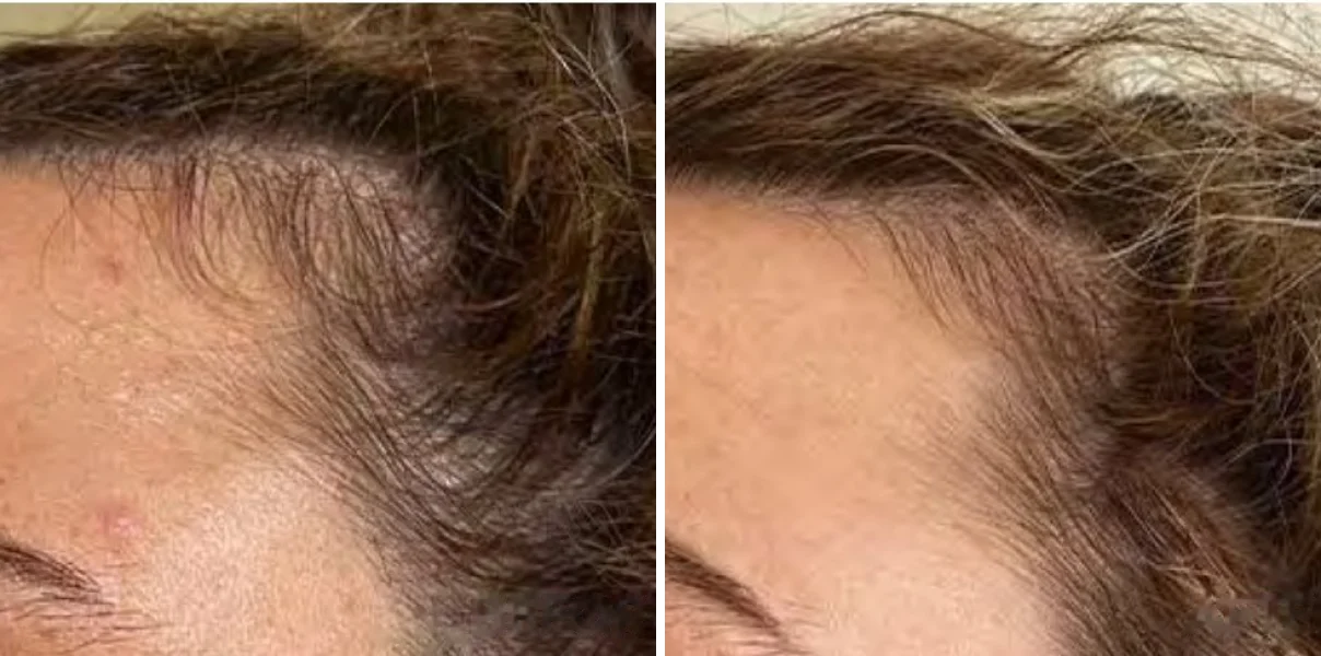 Before and after 8 weeks of liquid marine collagen: a woman's hair before and after
