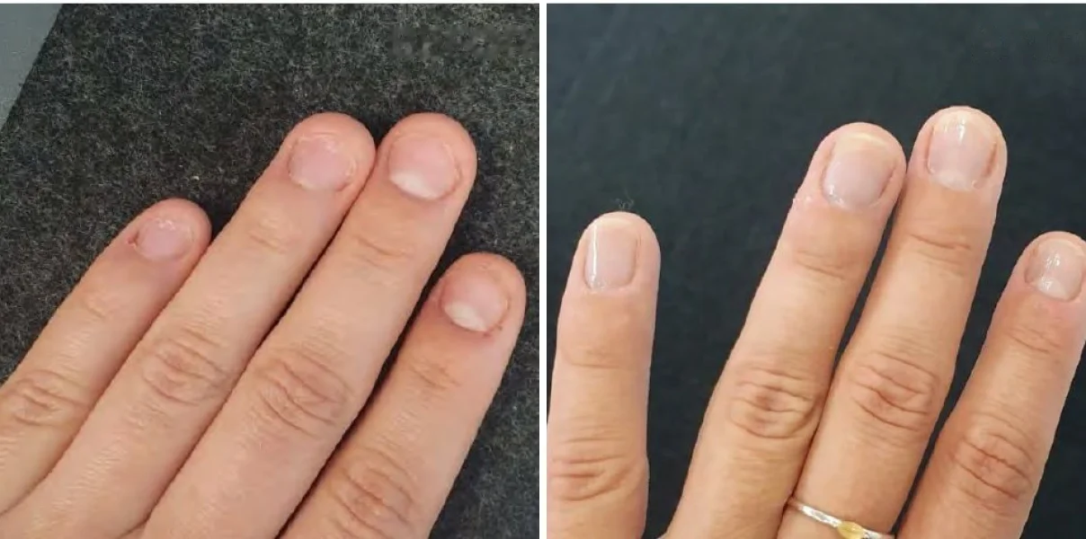 A woman's fingernails before and after 8 weeks of liquid marine collagen