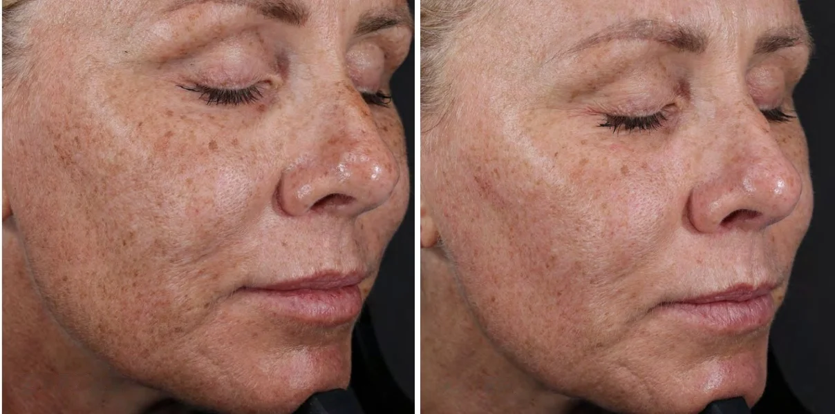 Before and after 8 weeks of liquid marine collagen: smoother, more even skin on a woman's cheek and eye area after