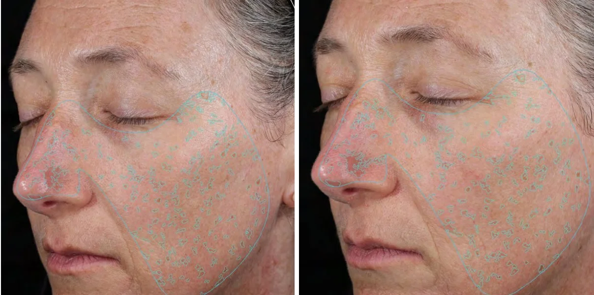 Skin-imaging analysis of a woman's cheek before and after 8 weeks